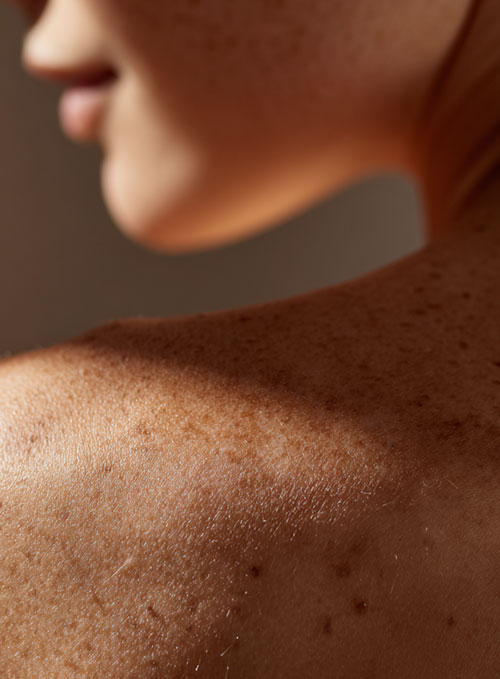 Der Rücken einer jungen Frau mit vielen Muttermalen