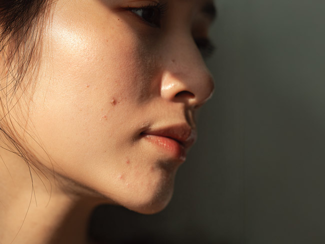 Nahaufnahme eines Gesichts mit sichtbarer Akne
