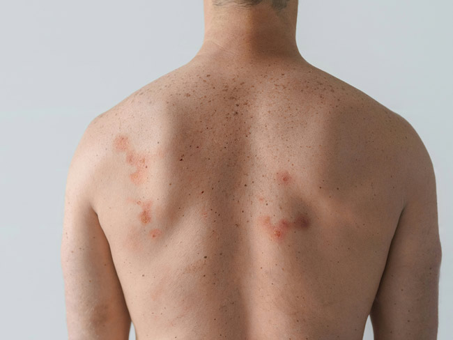 Rücken eines Mannes mit mehreren rötlichen Ekzemen und zahlreichen Sommersprossen auf der Haut.