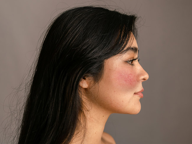 Seitliche Ansicht einer Person mit starken Rötungen an den Wangen (Rosazea / Couperose) langen, dunklen Haaren vor dunkelbraunem Hintergrund.