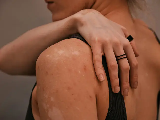 Schulter und Rücken einer Person mit unregelmäßigen, hellen Hautflecken, die Hand liegt auf der Schulter.