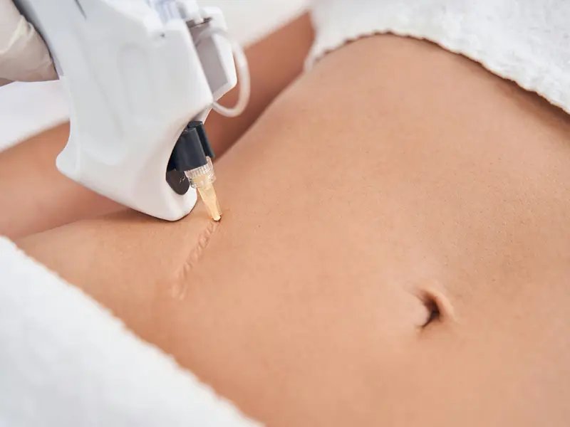 Eine Nahaufnahme eines Bauchs mit einer sichtbaren, länglichen Narbe. Ein medizinisches Gerät mit einer weißen Kunststoffhülle wird von einer Person mit Handschuhen gehalten und berührt die Narbe. Die Haut ist hell und glatt, der Bauchnabel ist sichtbar. Die Szene vermittelt eine Behandlungssituation in unserer Hautarztpraxis, bei der die Narbe mit einem Lasergerät behandelt wird.