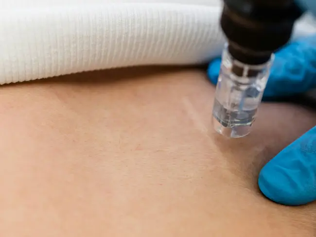 Eine Nahaufnahme zeigt eine Hautbehandlung, bei der ein medizinisches Gerät mit einer transparenten Spitze auf die Haut aufgesetzt wird. Die Haut ist glatt und hell, und eine Person trägt blaue Handschuhe, die das Gerät halten. Im Hintergrund ist ein weißes, gerolltes Tuch zu sehen.